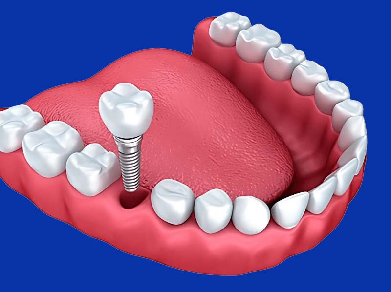 implantes-background